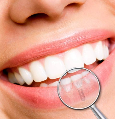 implante-dentario-eclinic